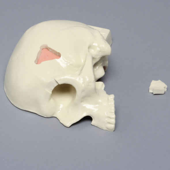Skull, Half, with Brain and Craniotomies
