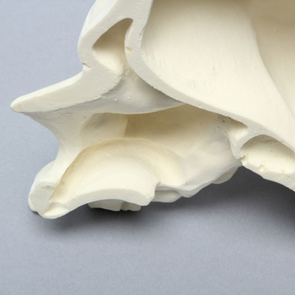 Skull, Right Partial, with Knife Ridge Defect