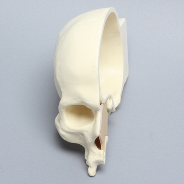 Skull, Right Partial, with Knife Ridge Defect