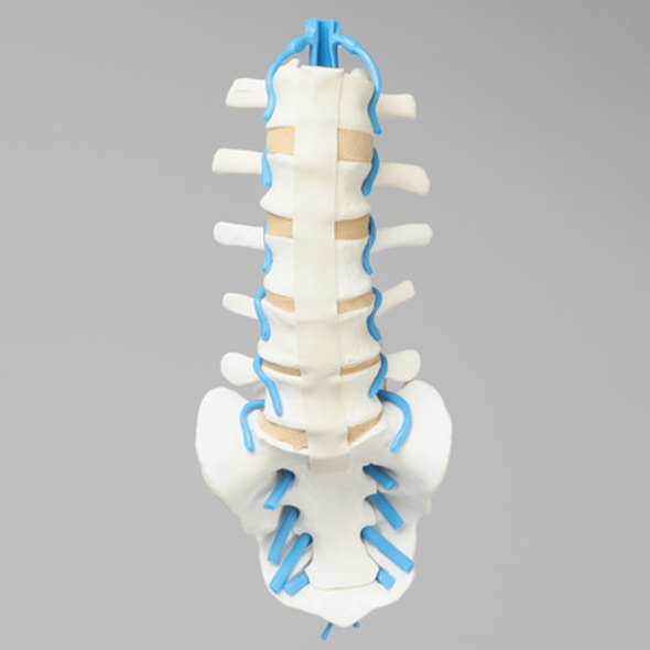 Spine, Lumbar with L3-L5 Stenosis, Solid Foam