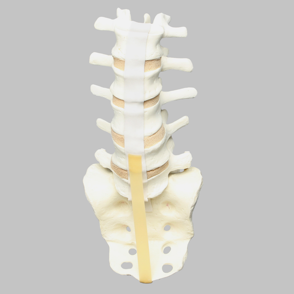 Spine, Lumbar, L5-Sacrum Spondylolisthesis, Solid Foam