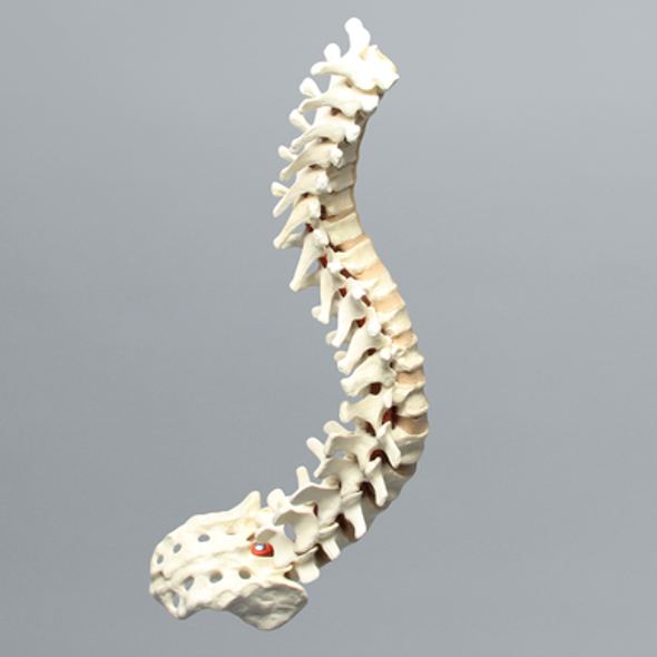 Spine, Scoliosis, T1-Sacrum with 15 degree Rotation, Solid Foam