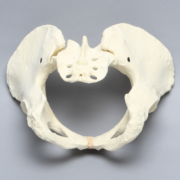 Pelvis with Dysplasia, Full Female, Solid Foam