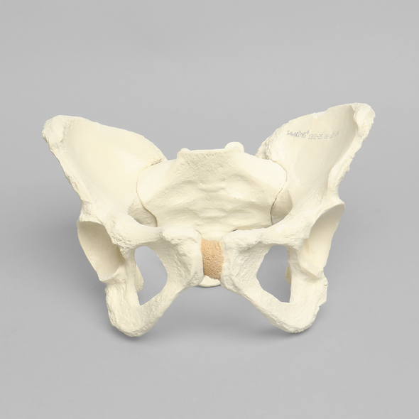 Pelvis with Dysplasia, Full Female, Solid Foam