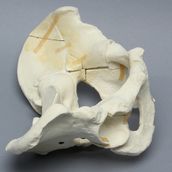 Pelvis with "T" and Both-Column Fractures, Full Male, Foam Cortical