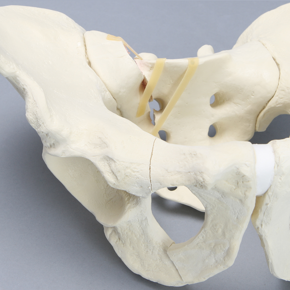 Pelvis with Sacral and Rami Fractures with Displacement, Full Male, Foam Cortical