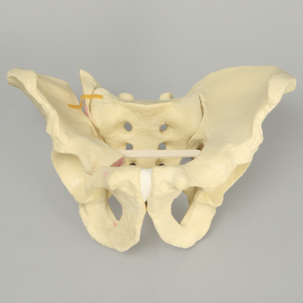 Pelvis with Rami and SI Fractures with Dislocation, Full Male, Foam Cortical