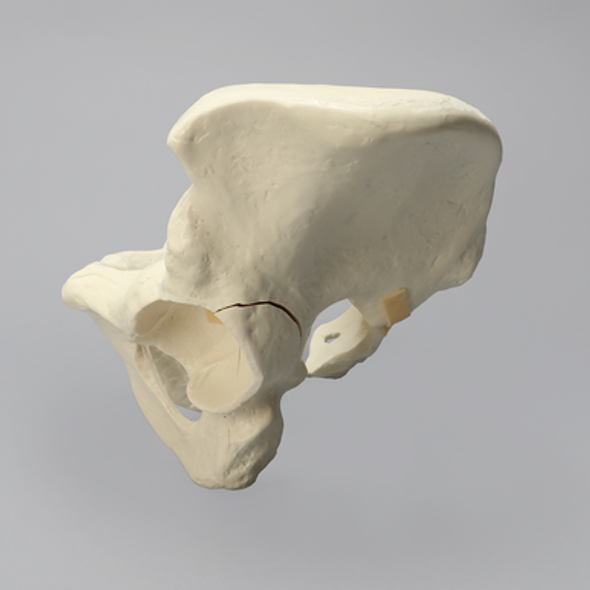 Pelvis with Disruption and Wall Fractures, Full Male, Solid Foam