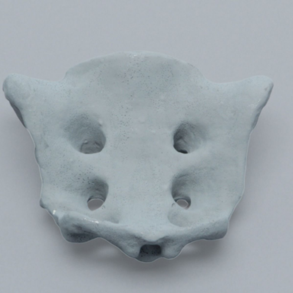 Sacrum, Radiopaque