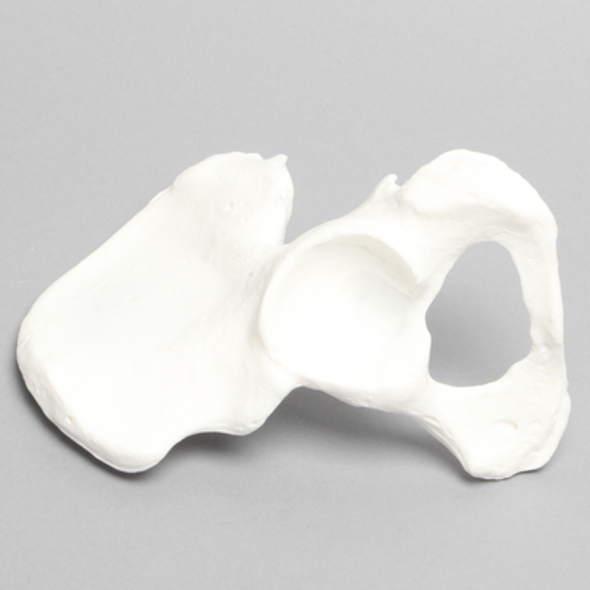Hemi Pelvis, Female, Solid Foam, With Dysplasia, Left