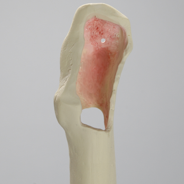 Femur with Segmental Defect and Perforated Wall