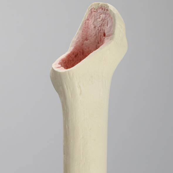 Femur with Focal Deficiency Type 1