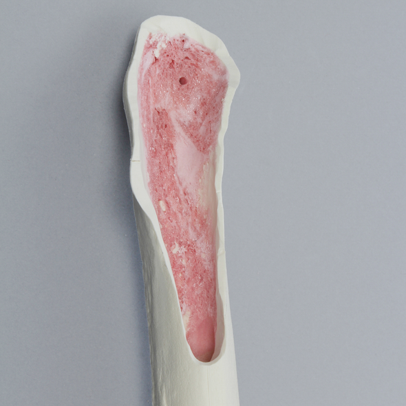Femur with Cortex Wall Loss