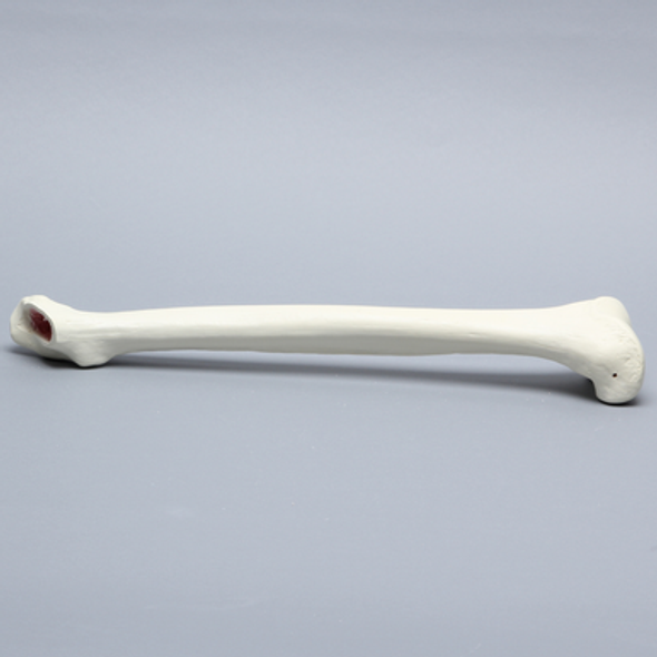 Femur with Broached Proximal Cavity