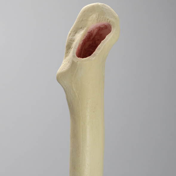 Femur with Broached Proximal Cavity and Midshaft Plug