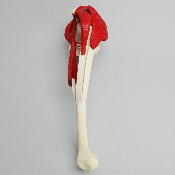 Hemi Pelvis with Erosion, Muscles, and Torn Labrum