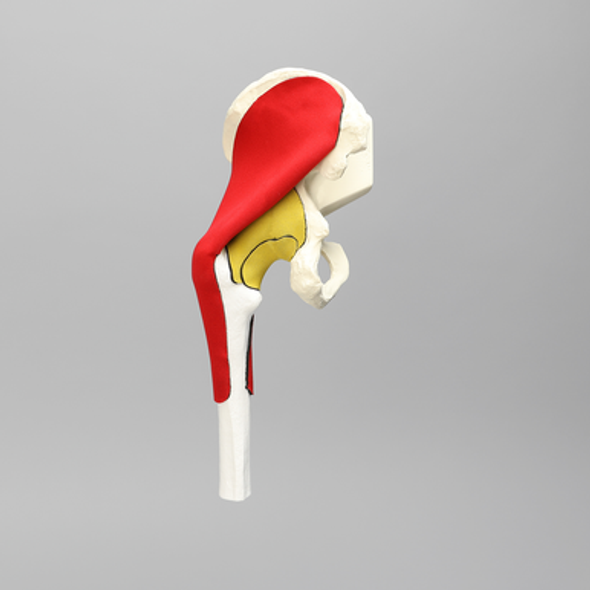 Hemi Pelvis, Encapsulated with Proximal Femur
