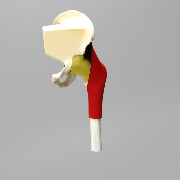 Hemi Pelvis, Encapsulated with Proximal Femur