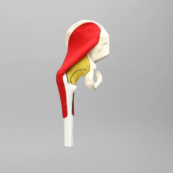 Hemi Pelvis, Encapsulated with Proximal Femur