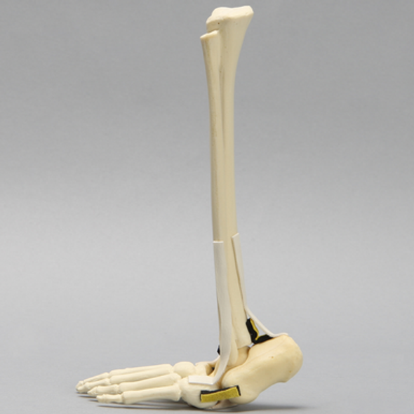 Foot and Ankle with Vertical Talus Pathology, Pediatric