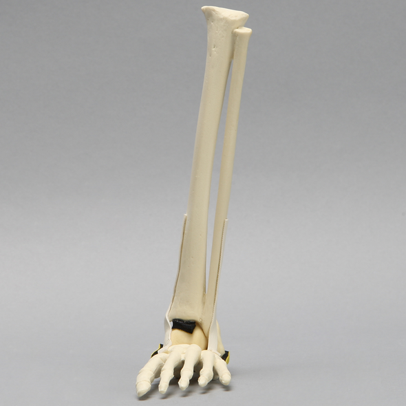 Foot and Ankle with Vertical Talus Pathology, Pediatric
