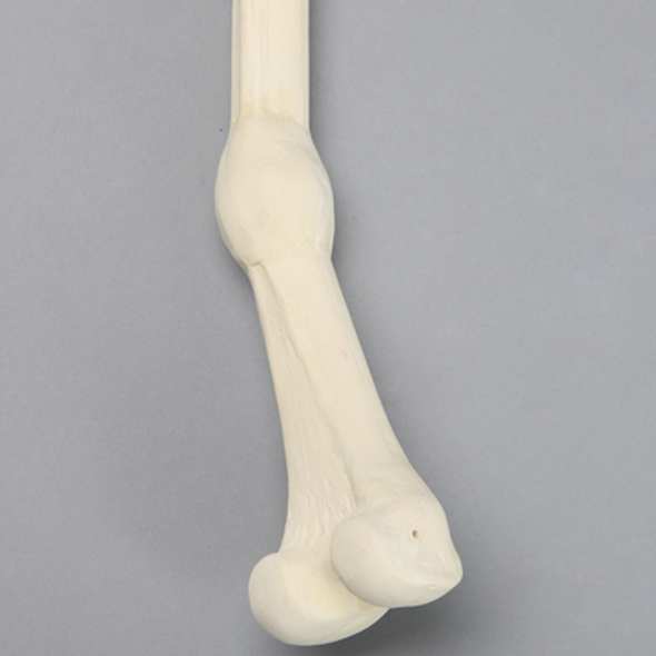 Femur with Distal Malunion and 35 Degree Rotation
