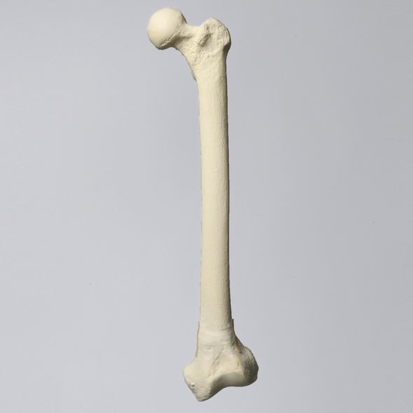 Femur with 10 Degree Valgus Deformity