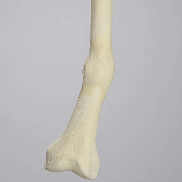 Femur with Distal Malunion and 45 Degree Rotation
