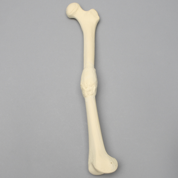 Femur with Midshaft Malunion and Anteversion