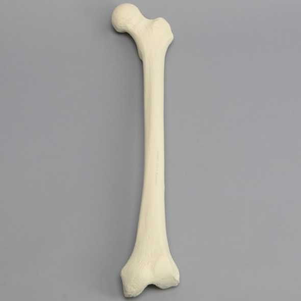 Femur with Hypoplastic Condyle Defect