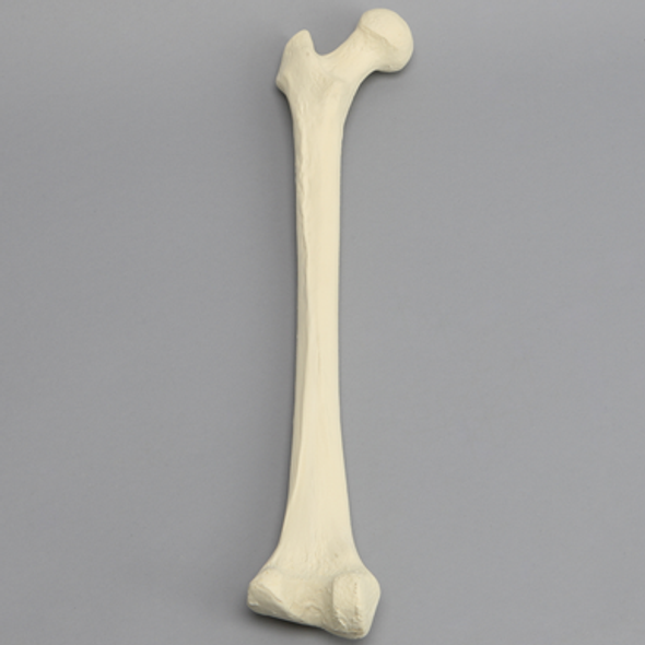 Femur with Hypoplastic Condyle Defect