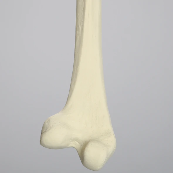 Femur with Distal Valgus Deformity and Rotation