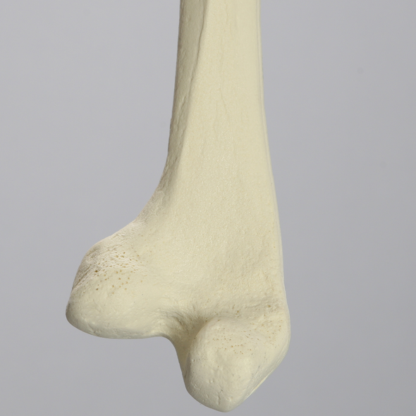 Femur with 25 Degree Distal Valgus Deformity
