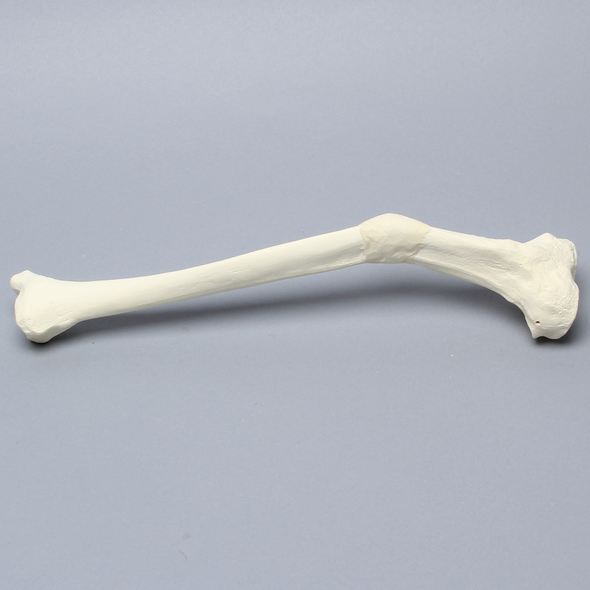 Tibia with Malunion and 25 Degree Valgus Defect