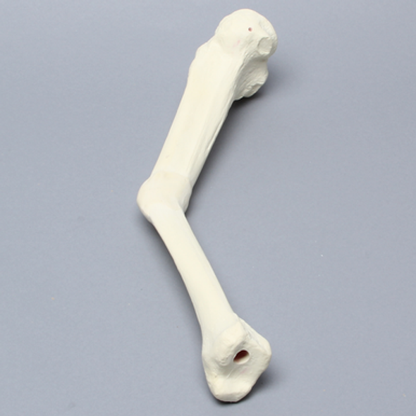 Tibia with Malunion and 20 Degree Procurvatum