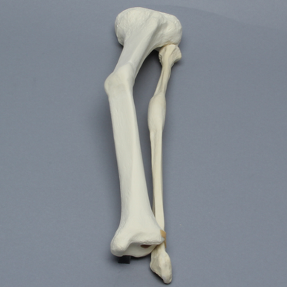 Tibia and Fibula with Malunions, Varus, and Procurvatum