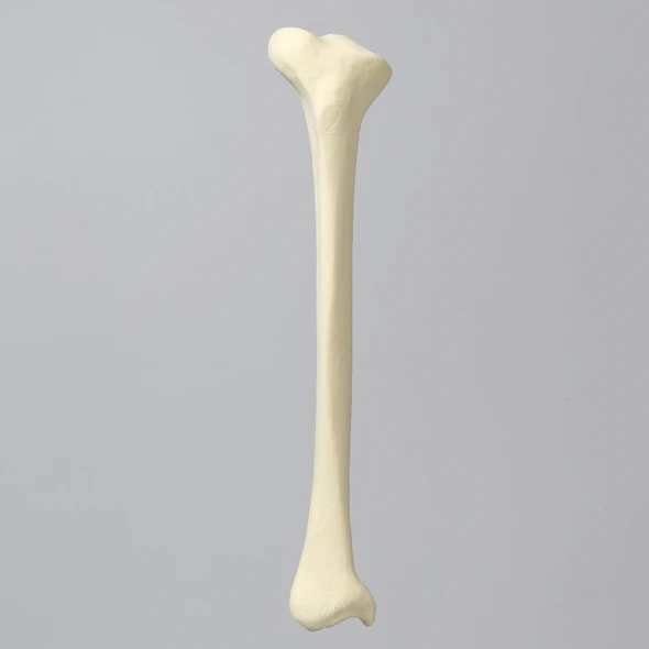 Tibia with Blount's Disease and Varus Deformities, Solid Foam