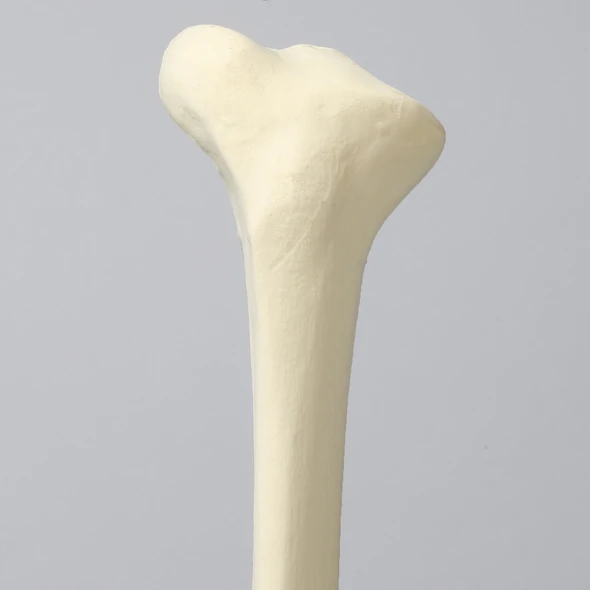 Tibia with Blount's Disease and Varus Deformities, Solid Foam