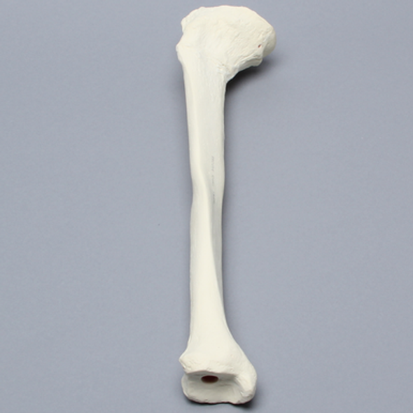 Tibia with Midshaft Malunion and Blount's Disease