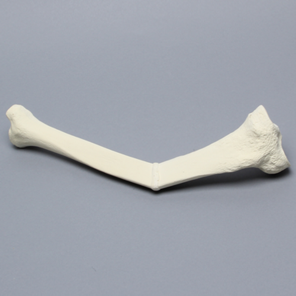 Tibia with Malunion and 25 Degree Procurvatum