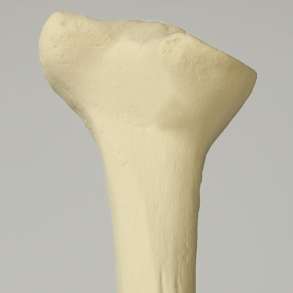 Tibia with Proximal and Distal Deformity