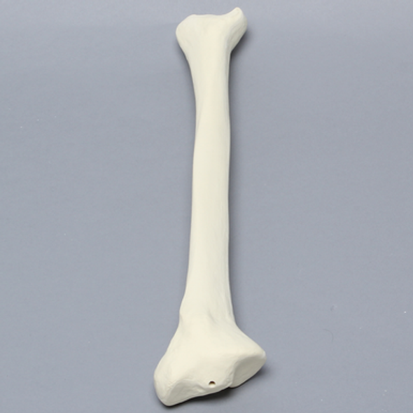 Tibia with 30 Degrees Varus Defect