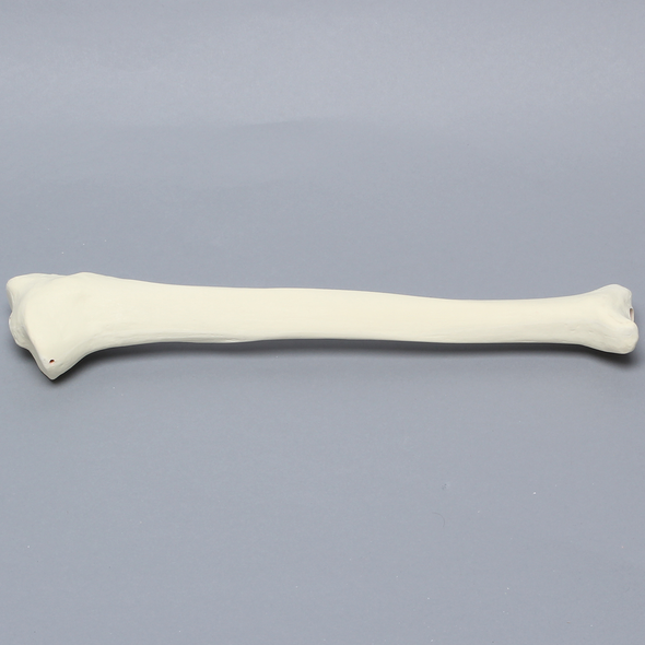 Tibia with 30 Degrees Varus Defect