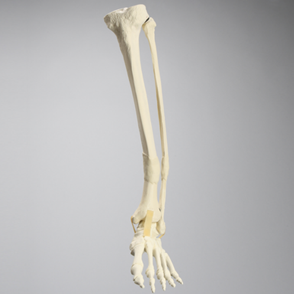 Foot and Ankle with Distal Malunion and Rotation