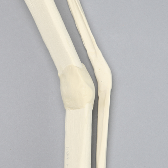 Tibia and Fibula with Malunions and 25º Varus Defect