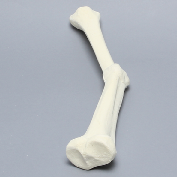 Tibia with Malunion and 20º Plane Defect, Solid Foam