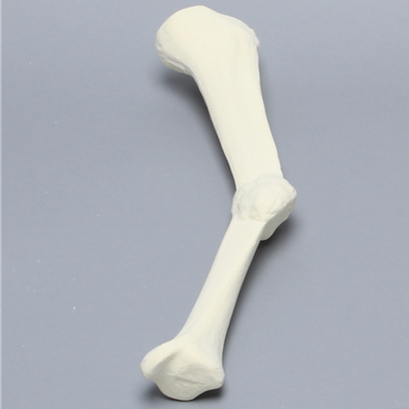 Tibia with Malunion and 20º Plane Defect, Solid Foam