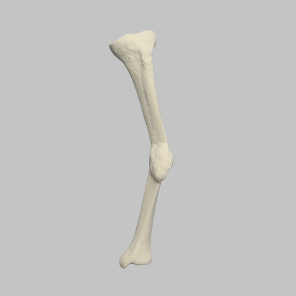 Tibia with Malunion and 20º Plane Defect, Solid Foam