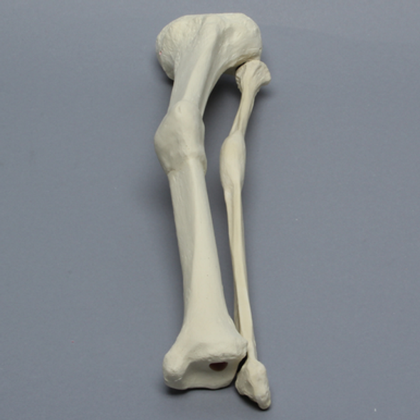 Tibia and Fibula with Malunions and Plane Defect