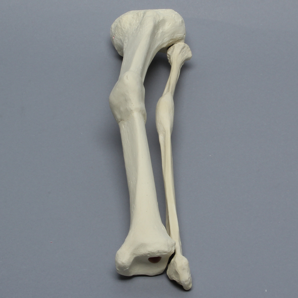 Tibia and Fibula with Malunions and Plane Defect